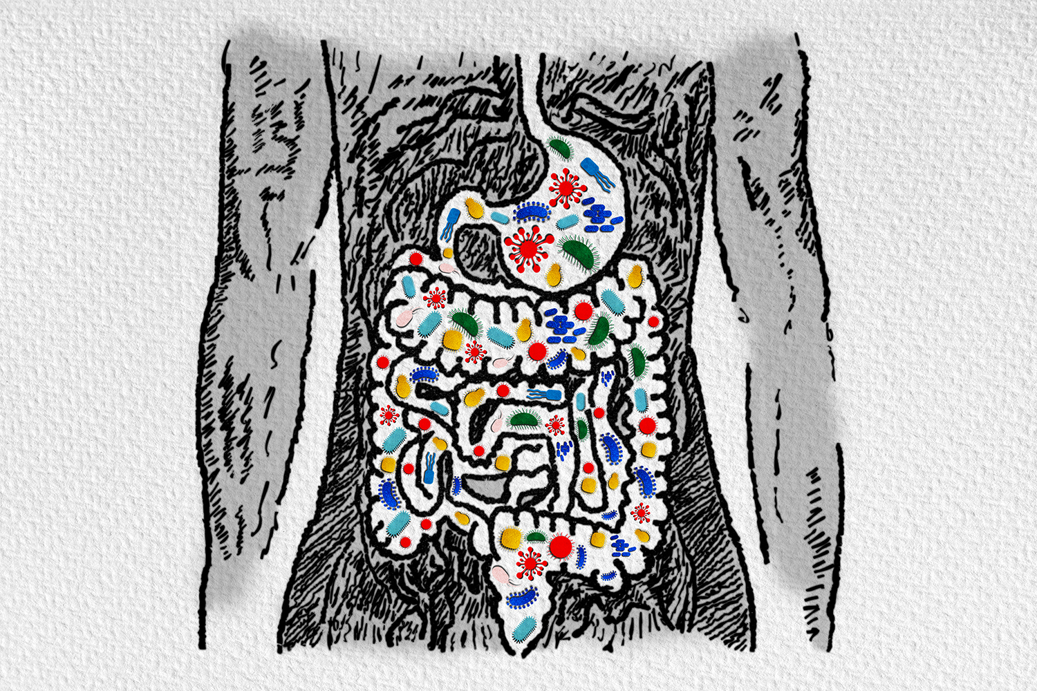 a cartoon x-ray of an inflammed intestine, with leaky gut, dysbiosis and SIBO